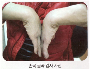 손목터널증후군 수술